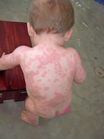 Bactrim Allergy Rash