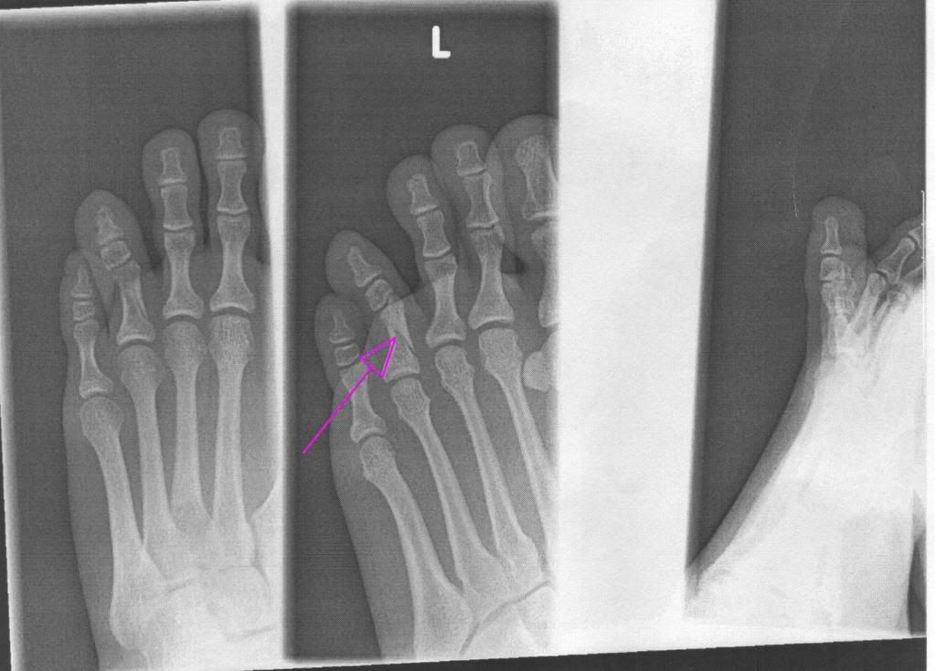 Broken Toe X-Ray